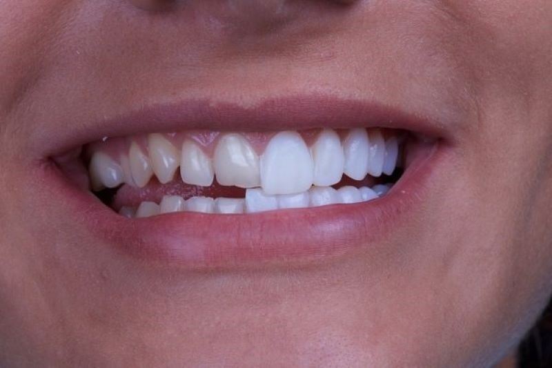 Chức năng ăn nhai và tính thẩm mỹ được cải thiện sau khi bọc sứ cho răng mọc chìa. 